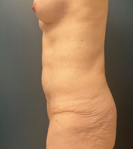 After Weight Loss case #19080