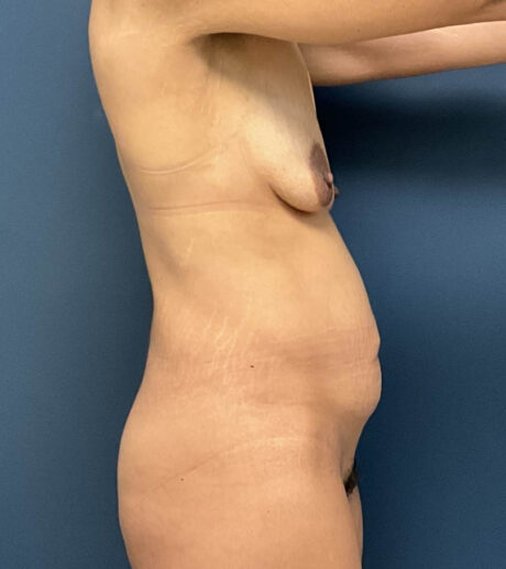 Breast Augmentation With Lift case #18622