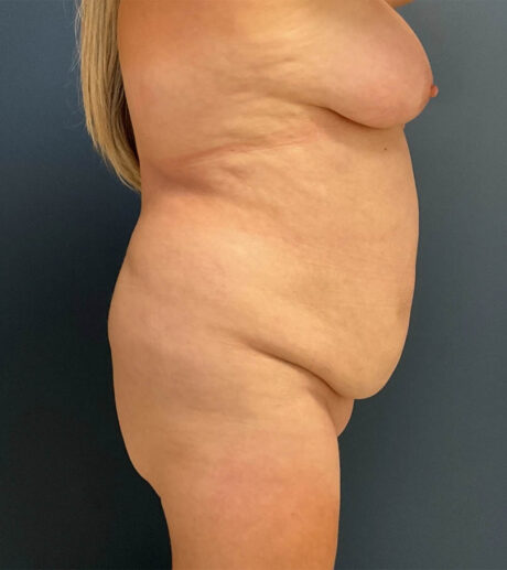Liposuction case #19224