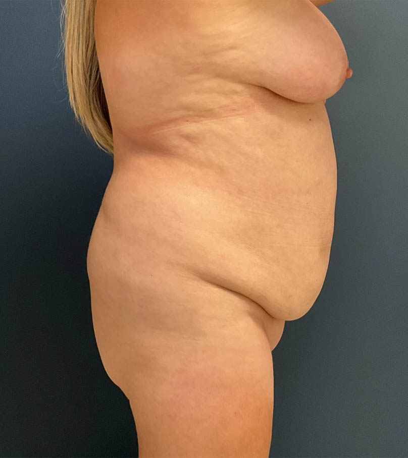Liposuction case #19224