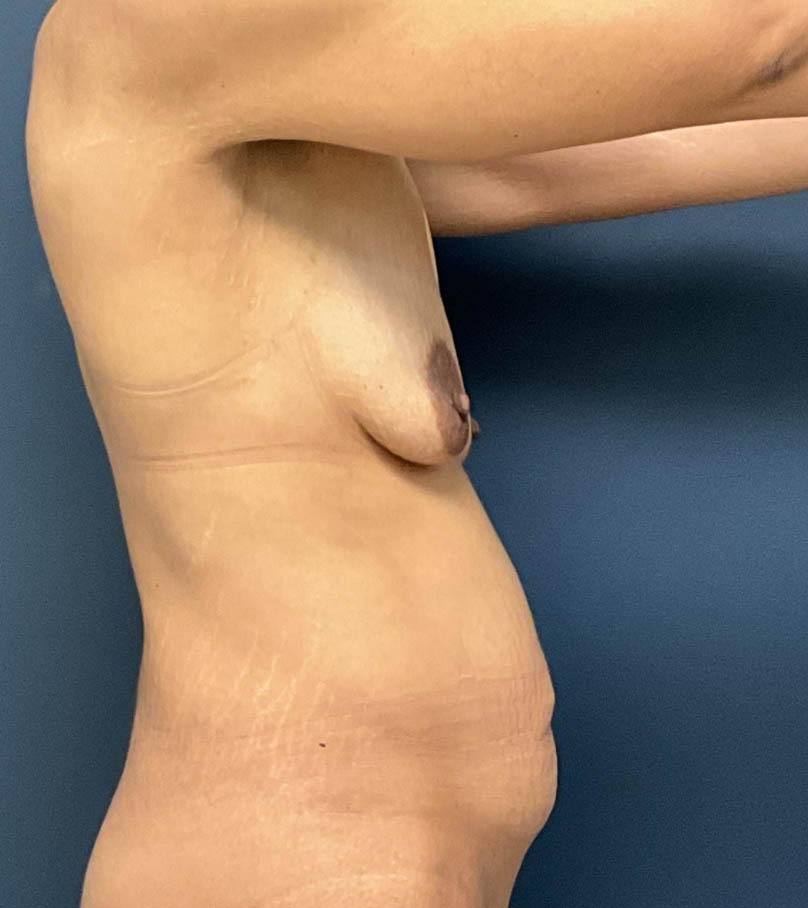 Breast Augmentation With Lift case #18757