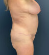 Liposuction case #19224