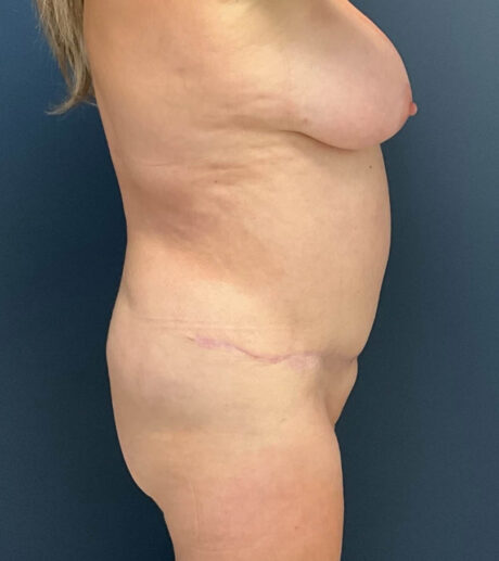 Liposuction case #19224