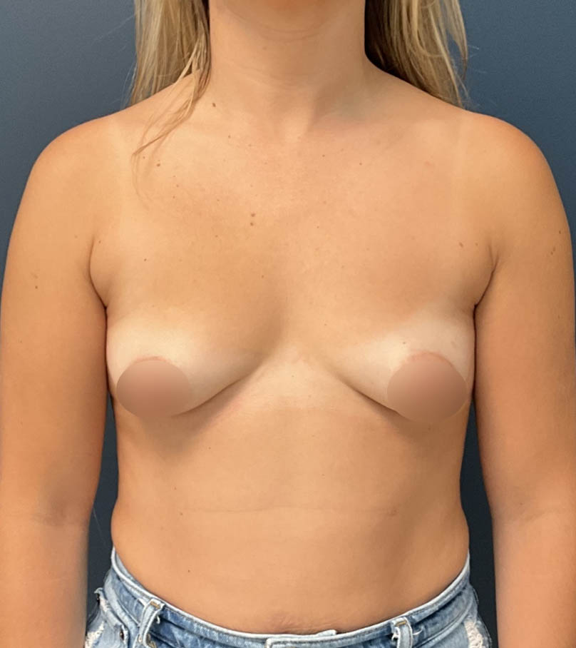Breast Augmentation case #18758