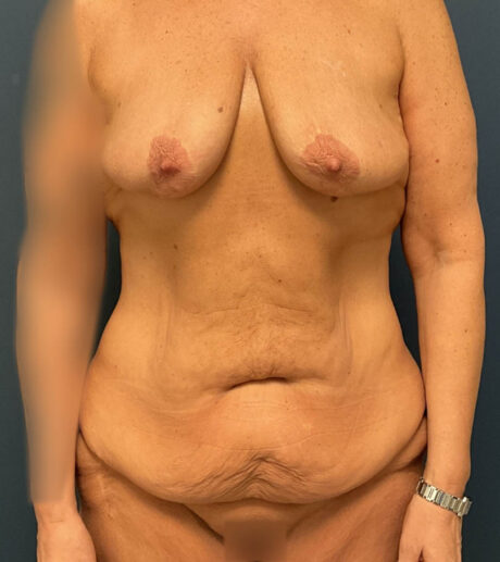 After Weight Loss case #18629