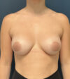 Breast Augmentation case #18758