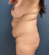 Tummy Tuck case #19234