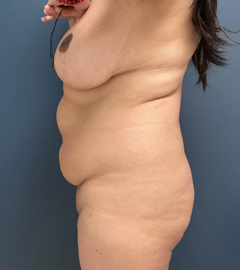 Tummy Tuck case #19234