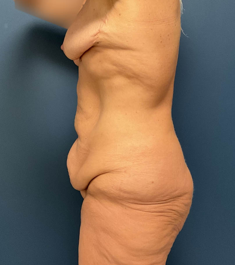 After Weight Loss case #18629