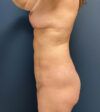 Breast Lift case #19088
