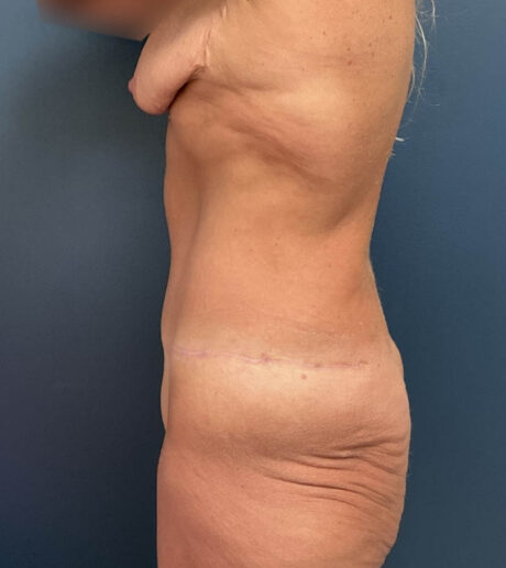 After Weight Loss case #18629