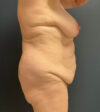 Breast Lift case #19097