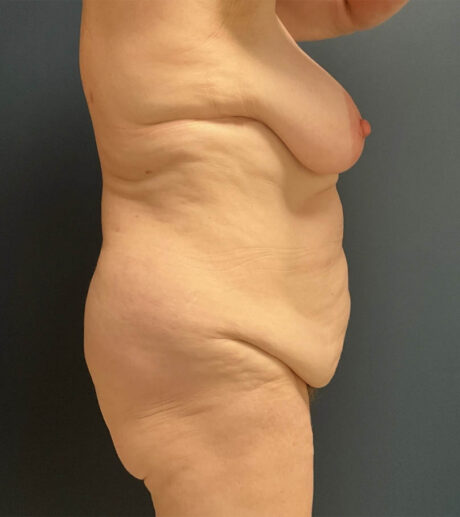 Breast Lift case #19097