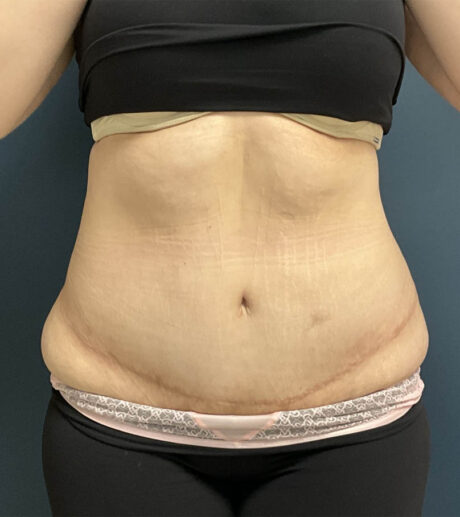 Tummy Tuck case #18636