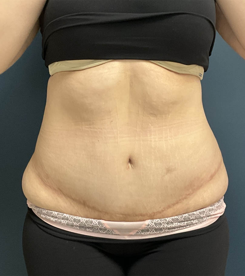 Tummy Tuck case #18636