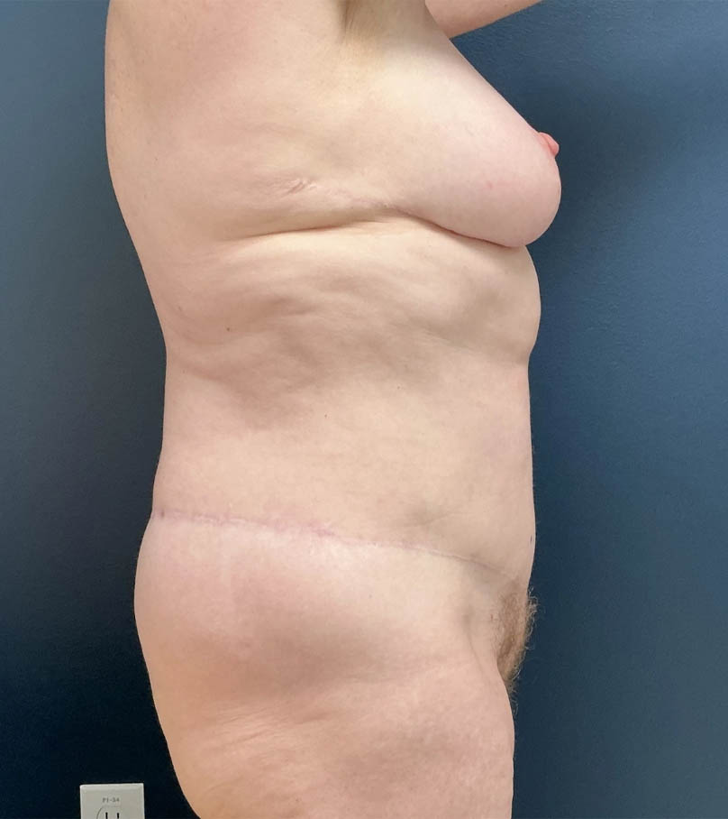 Breast Lift case #19097