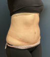 Tummy Tuck case #18636