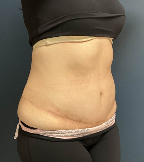Tummy Tuck case #18636