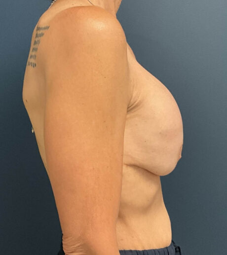 Breast Implant Exchange case #18950
