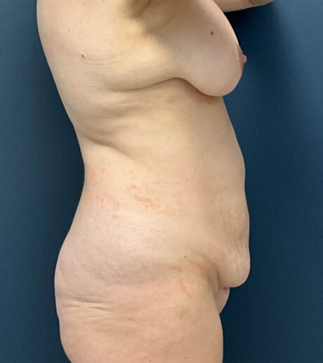 Tummy Tuck case #19241