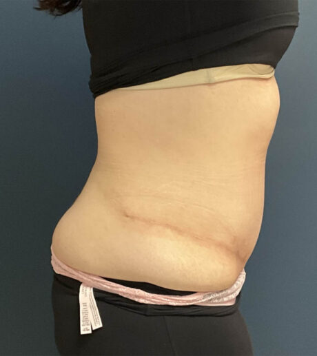 Tummy Tuck case #18636