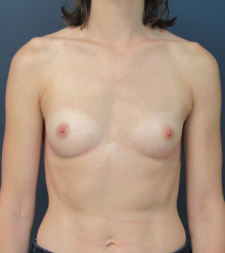 Breast Augmentation case #18774