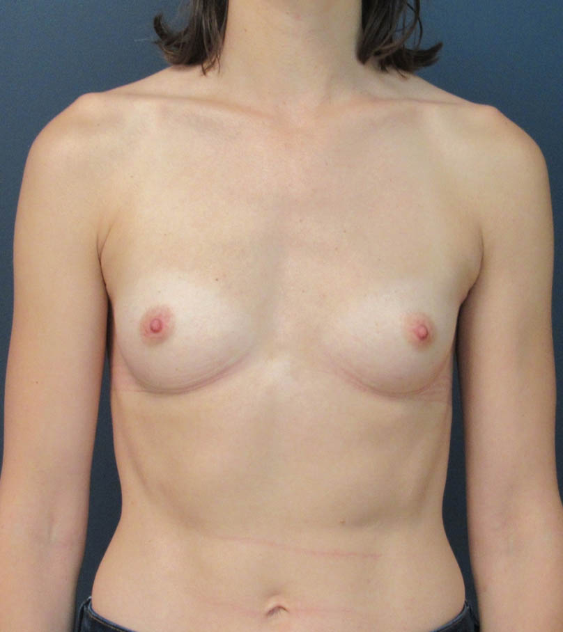 Breast Augmentation case #18774