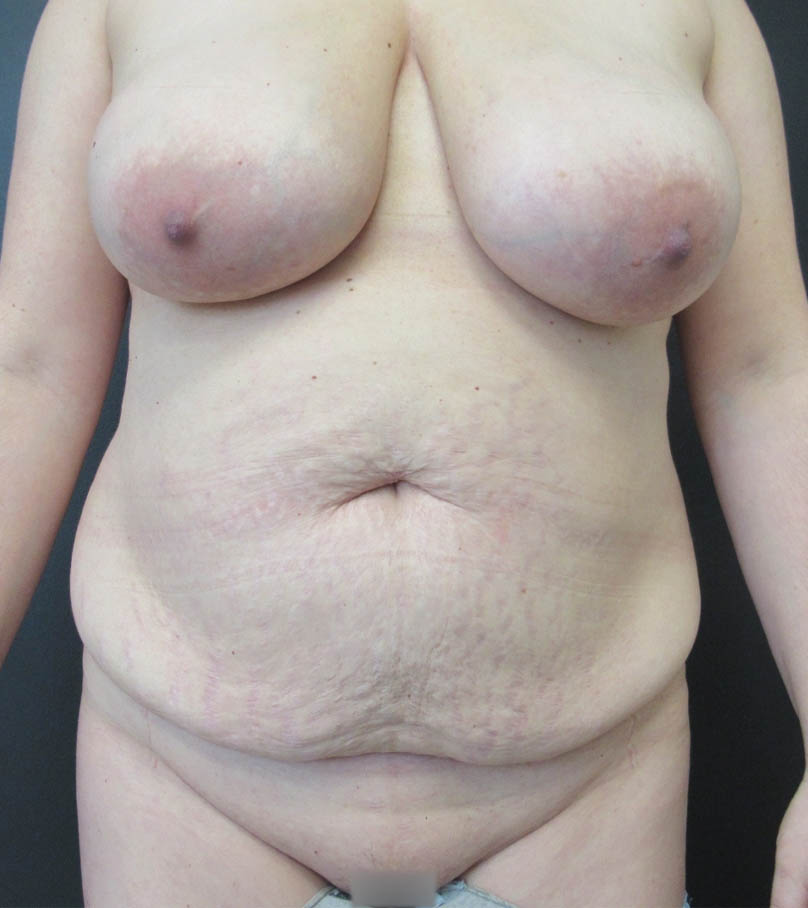 Breast Lift case #19248