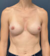 Breast Augmentation case #18774