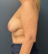 Breast Lift case #19104