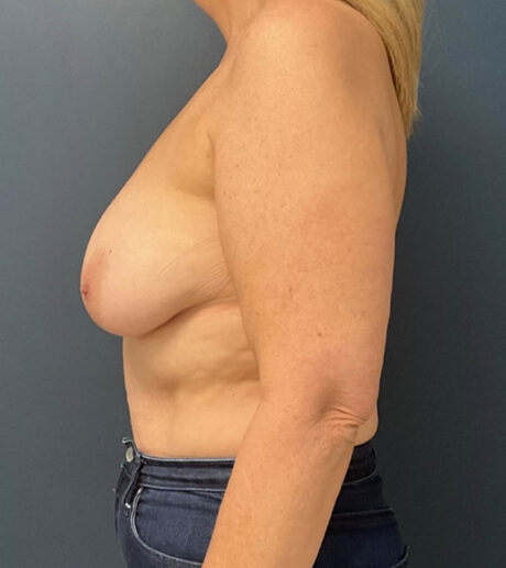 Breast Lift case #19104