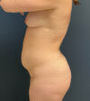 Tummy Tuck case #18643