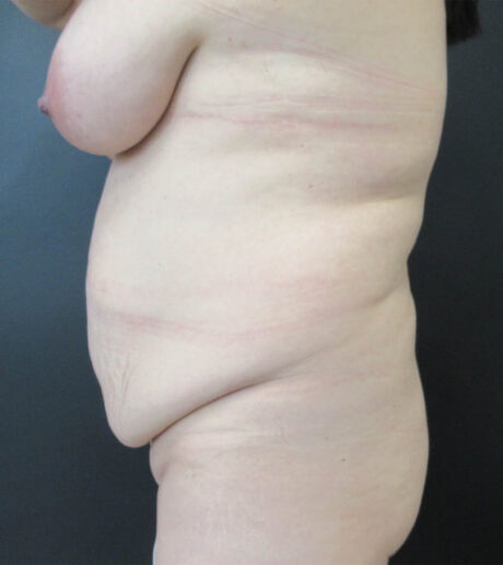 Breast Lift case #19248
