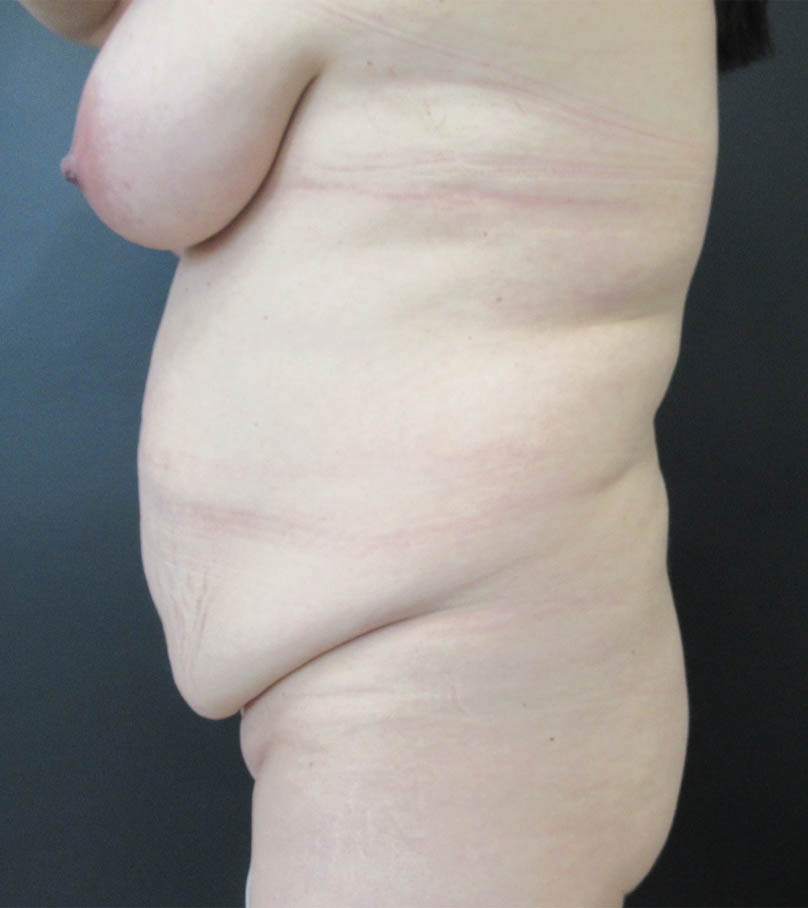 Breast Lift case #19248