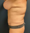 Breast Lift case #19248