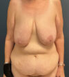 Breast Lift case #19111