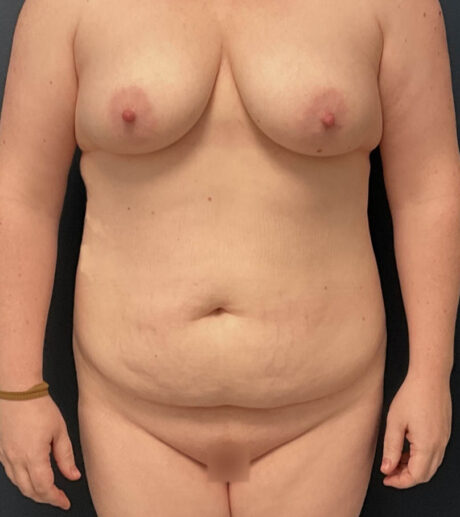 Tummy Tuck case #18650