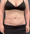 Tummy Tuck case #18650