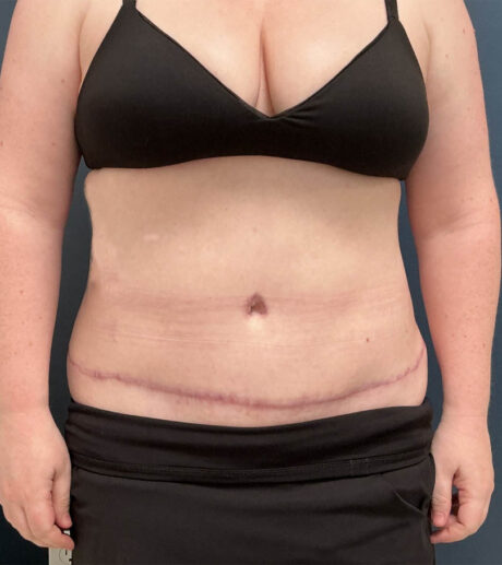 Tummy Tuck case #18650