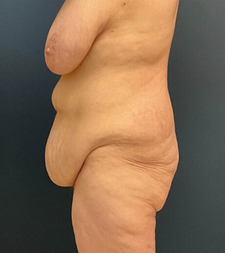 Breast Lift case #19111