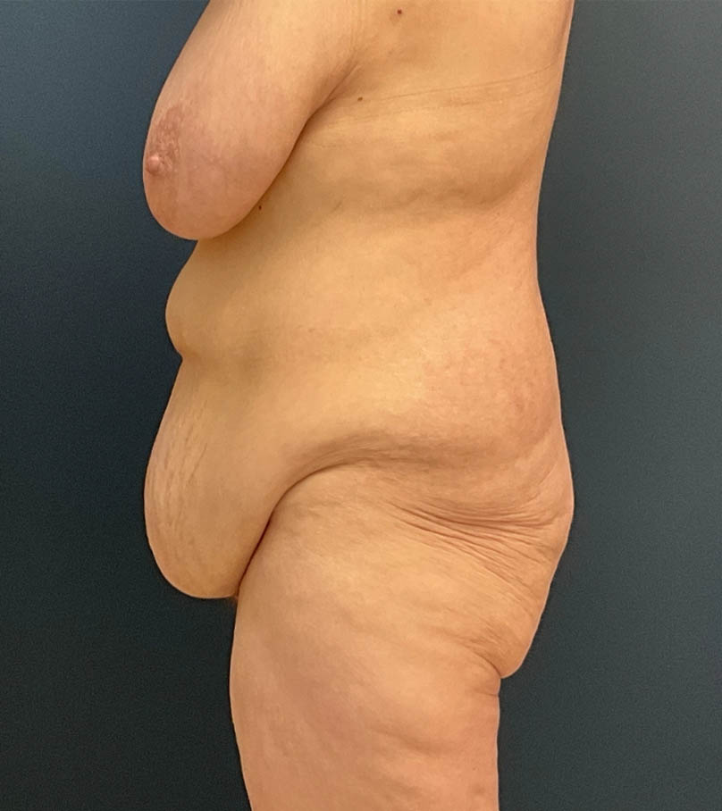 Breast Lift case #19111