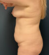 Tummy Tuck case #18650
