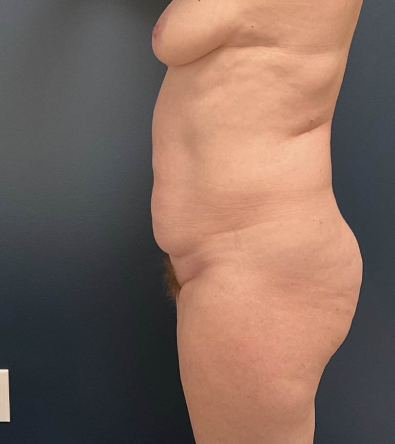 Tummy Tuck case #19255