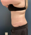 Tummy Tuck case #18650