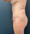 Tummy Tuck case #19255