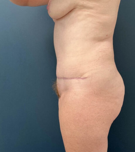Tummy Tuck case #19255