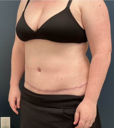 Tummy Tuck case #18650