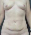 Breast Augmentation case #19118