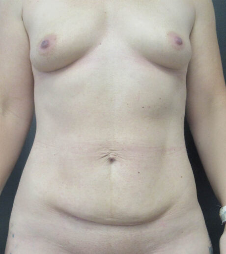 Breast Augmentation case #19118