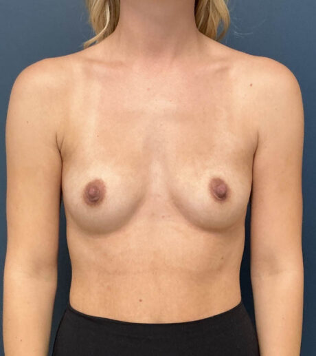 Breast Augmentation case #18788